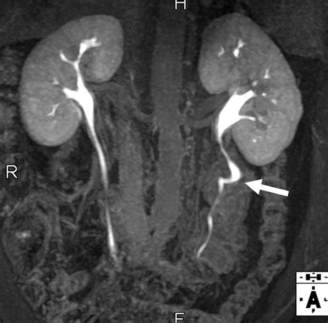 What Is A Mri Urogram at Patrick Guinn blog