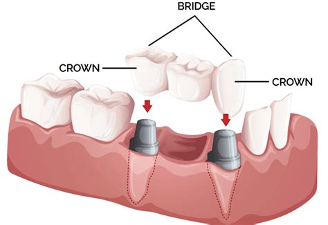 Crowns & Bridges - My Plantation Dentist - Heidi Finkelstein D.M.D.