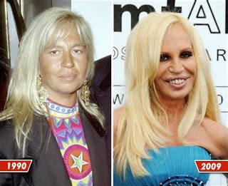 Donatella Versace Plastic Surgery Before and After Nose Job, Facelift ...