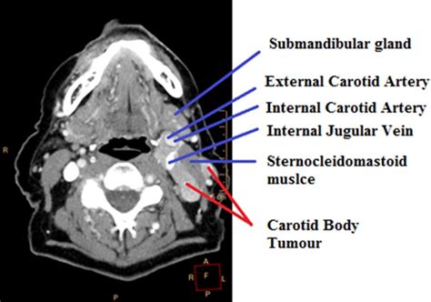 Jugular Veins Anatomy