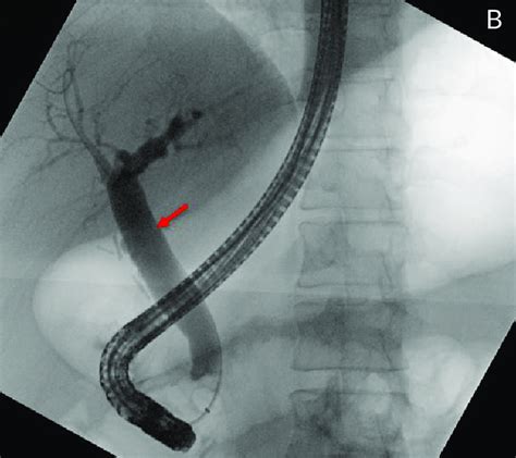 A Ultrasound Of The Right Upper Quadrant Showing A Dilated Common Bile Download Scientific