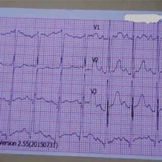 12 Lead Resting Surface Electrocardiogram Tracing On Patient Admission