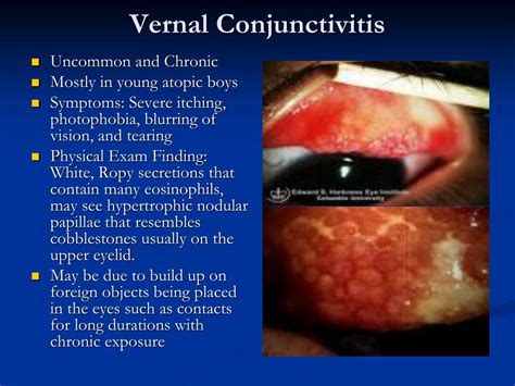 Ppt Allergy Immunology Board Review Powerpoint Presentation Free