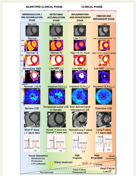 Proposed Stages Of Cardiac Involvement In Fabry Disease A New