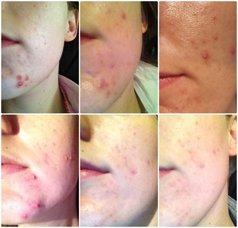 New Skin N Lite For Acne Review And Picture Update Beauty Geek Uk