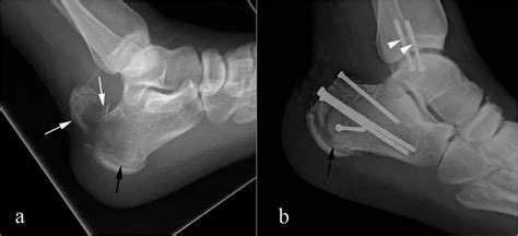 calcaneus radiology articlnet
