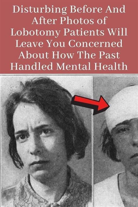 Disturbing Before And After Photos Of Lobotomy Patients Will Leave You