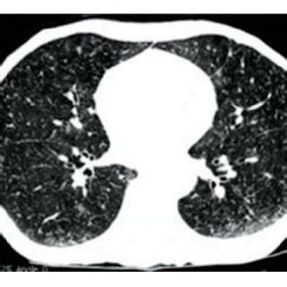 Chest CT images at (a) presentation and (b) fifth month of anti-TB ...