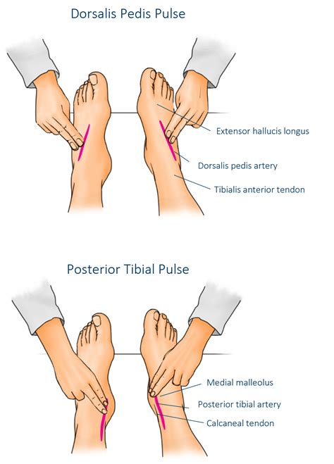 Liste Des Bonnes Pratiques De Pose Des Bandes CompressionGo