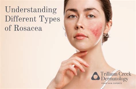 Understanding Different Types Of Rosacea Trillium Creek Dermatology