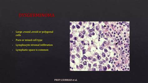 Germ Cell Tumors Of Ovary Pptpptx