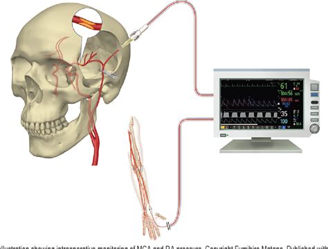 Figure 1 From Intraoperative Middle Cerebral Artery Pressure