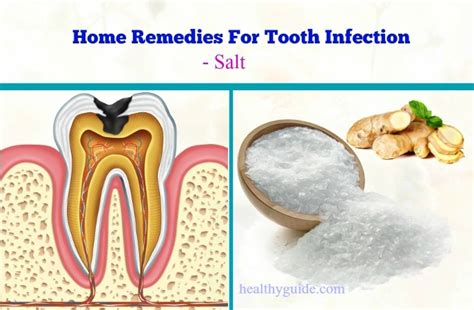 20 Best Natural Home Remedies for Tooth Infection Pain and Swelling