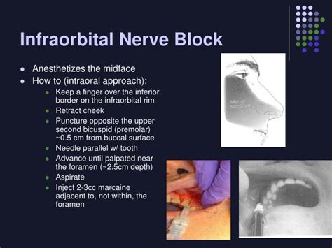 Infraorbital Nerve Block