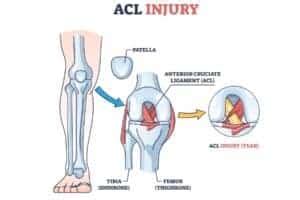 8 Best Exercises to Rehab a Torn ACL Without Surgery