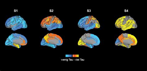 Four subtypes of Alzheimer's disease identified - distribution of the tau proteins causes ...