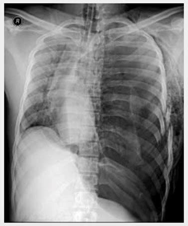 Tension Pneumothorax Assessment And Management Of Pediatric Trauma