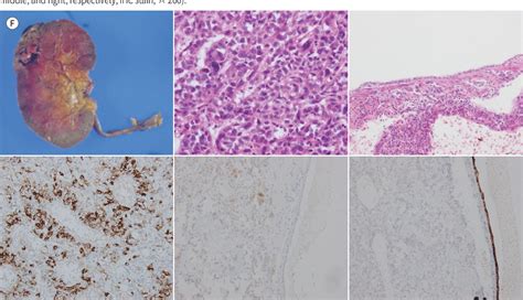 Figure 1 From Renal Epithelioid Angiomyolipoma With Epithelial Cysts