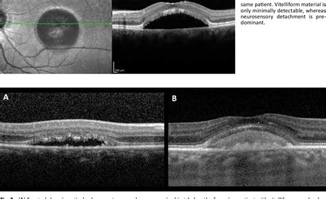 Figure 2 From Optical Coherence Tomography In Best Vitelliform Macular