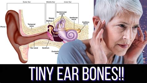 What You Need to Know About Ear Bones (Otosclerosis 101) - YouTube