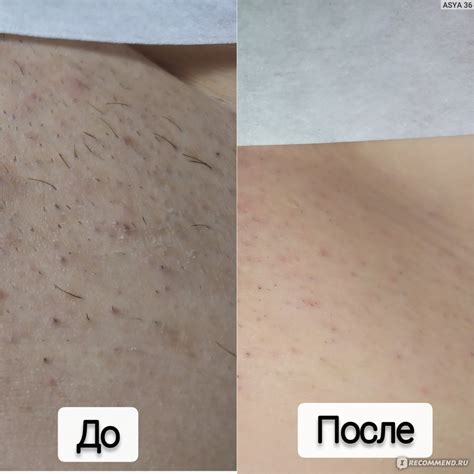 В зоне бикини врос волос: Как избавиться от вросших волос в зоне бикини ...