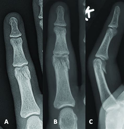 Proximal Phalanx Fracture Splint