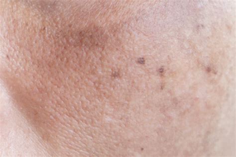 pigmentation im skin health