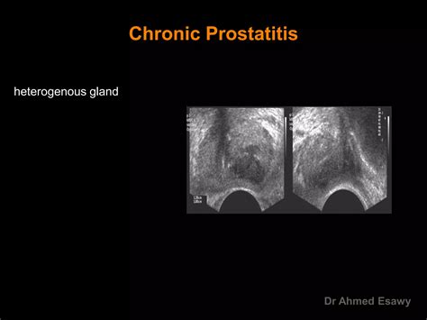 Imaging Prostatitis Urethritis Dr Ahmed Esawy Ppt