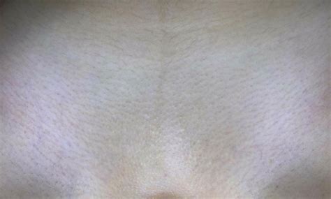 Depilacja Laserowa Bikini Warszawa