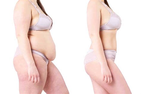 Best Tummy Tuck In Istanbul Turkey Best Clinics Prices