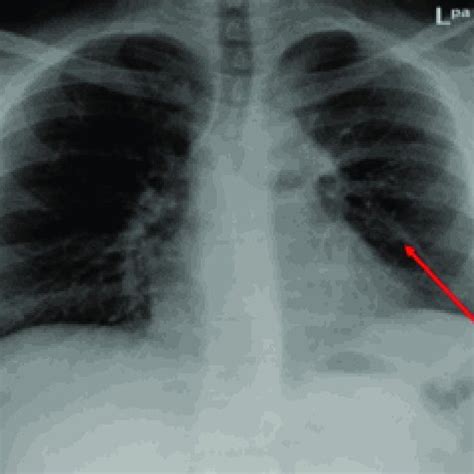 chest  ray  case  showing left lung mid zone opacity