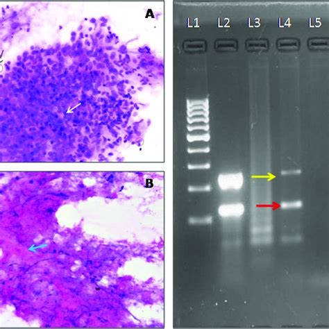 Fine Needle Aspiration Cytology Smears A Showing Multiple Epithelioid Download Scientific