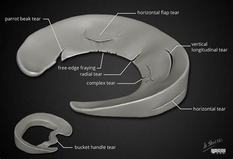 Meniscal Tear Causes, Presentation and Treatment | Bone and Spine