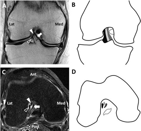 Figure 2 From Size And Shape Of The Human Anterior Cruciate Ligament