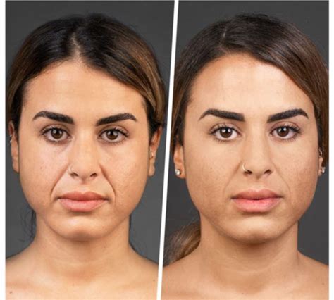 Nasolabial Fold Filler Before And After Filler Aesthetic