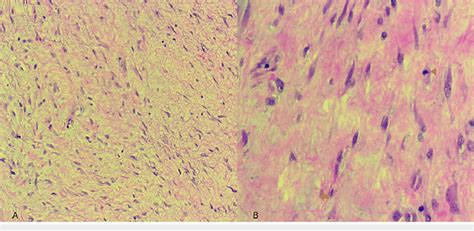 Histology Hematoxylin And Eosin Stain A The Tumor Was Composed Of Download Scientific