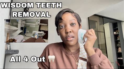 Storytime My Wisdom Teeth Extraction Surgery Ndinawe Chila Youtube