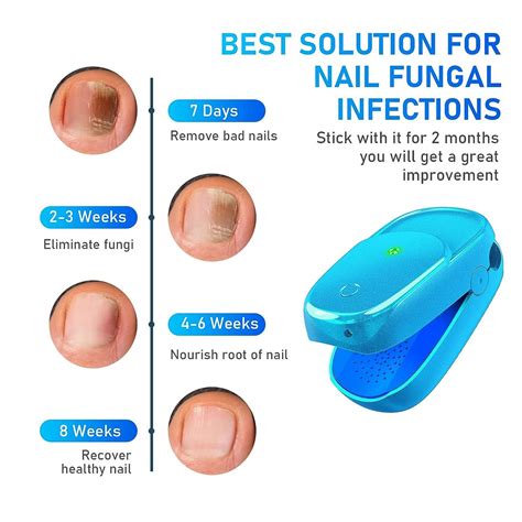 Nail Fungus Laser Treatment Device for Toenails and Fingernails - Home