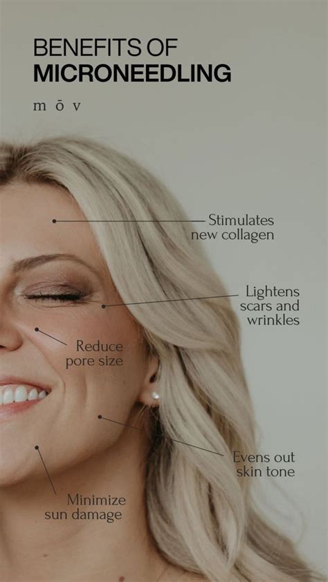 Microneedling Benefits In 2024 Skin Aesthetics Skin Facts Facial Aesthetics