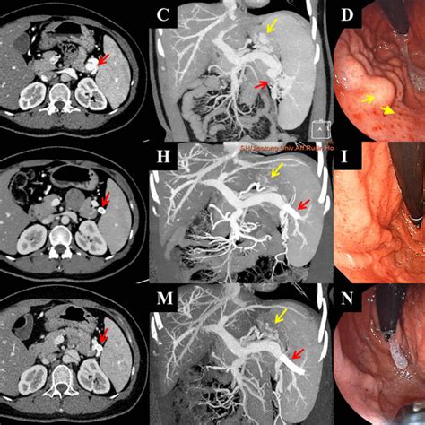 Preoperative And Postoperative Computed Tomography Findings From The