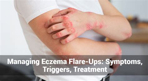 Managing Eczema Flare Ups Symptoms Triggers Treatment Eczemaless