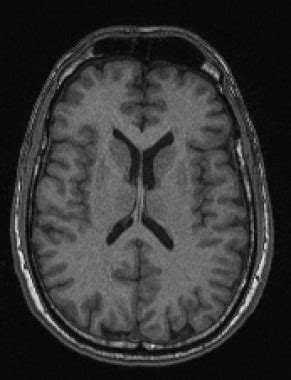 Brain Magnetic Resonance Imaging Technique Approach Considerations In