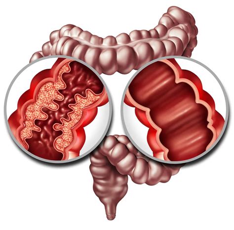 O Que É Suboclusão Intestinal - Occlusion intestinale : causes, symptômes et traitements appropriés