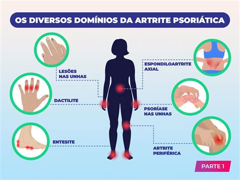 O Que Piora A Artrite Psoriática