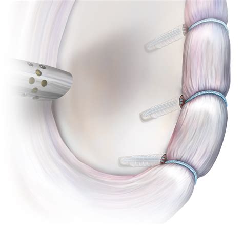 Arthrex Técnica SwiveLock para inestabilidad