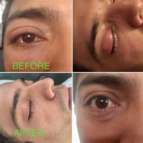 Best Ayurvedic Remedy for Eye Styes | HEAL Ayurveda