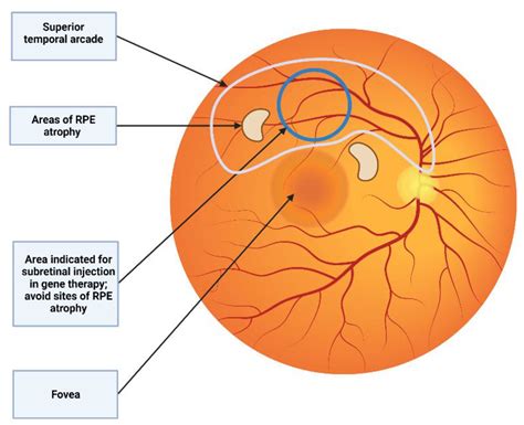 Jcm Free Full Text Subretinal Injection Techniques For Retinal