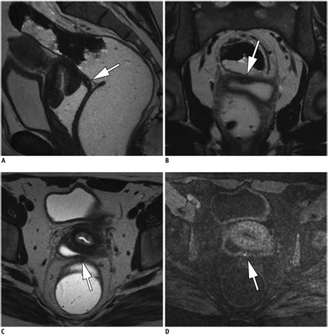 Pelvic Mri Is Endovaginal Or Rectal Filling Needed Abstract