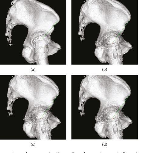 Figure From Bilateral Greater Trochanteric Avulsion Fractures After