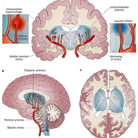 The Vascular Centrencephalon. Pathophysiology of lacunar infarction and
